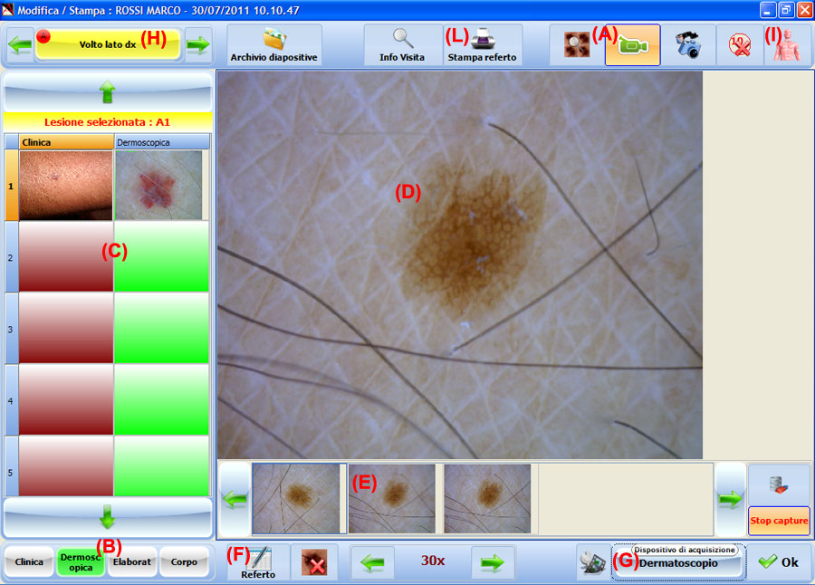Con Dermatec si può creare una nuova visita per la refertazione fotografica di immagini cliniche e dermoscopiche catalogate per tipologia e area del corpo. Viene mostrata anche l'anteprima video del dermatoscopio economico portatile in funzione che serve per l'acquisizione delle immagini delle lesioni come nei, nevi e melanomi.