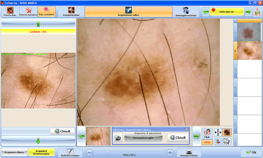 Con Dermatec si può creare una nuova visita per la refertazione fotografica di immagini cliniche e dermoscopiche catalogate per tipologia e area del corpo. Viene mostrata anche l'anteprima video del dermatoscopio economico portatile in funzione che serve per l'acquisizione delle immagini delle lesioni come nei, nevi e melanomi.