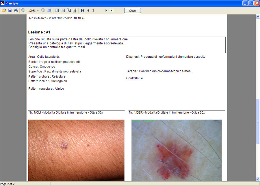 Anteprima di un referto visita prodotto con Dermatec. La dermoscopia portatile permette differenti tipi di esame, dal semplice screening delle lesioni melanocitiche pigmentate ai sospetti casi di neoplasia cutanea, fino alla diagnosi differenziale delle connettiviti a carattere autoimmune.