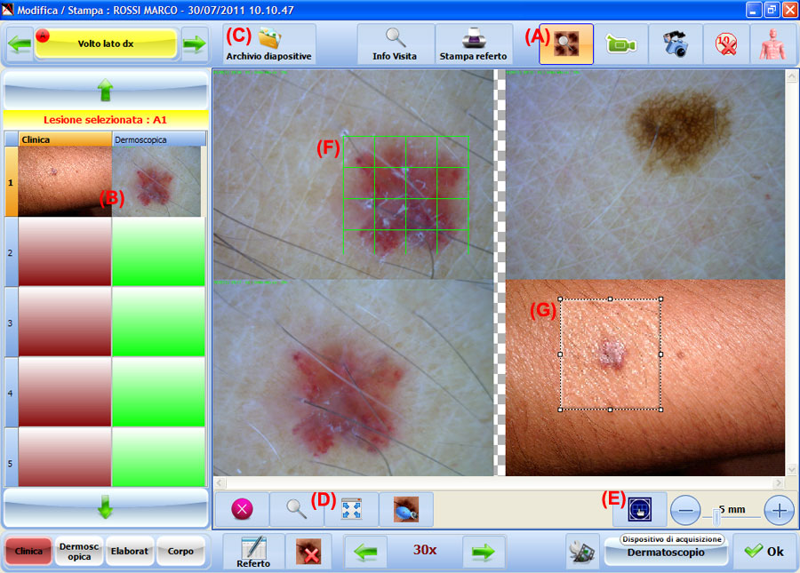 Comparazione ed elaborazione di immagini con Dermatec. Il monitoraggio dermoscopico con dermatoscopio economico portatile consiste invece nell'acquisizione e nel confronto nel tempo di immagini dermoscopiche di lesioni melanocitarie opportunamente selezionate, al fine di evidenziare precocemente modifiche indicative di atipia cito-architetturale.L'impiego combinato delle due metodiche permette di individuare in maniera oggettiva la comparsa di nuove lesioni melanocitarie e di studiarne caratteristiche ultrastrutturali ed evolutive, ottimizzandone la gestione.