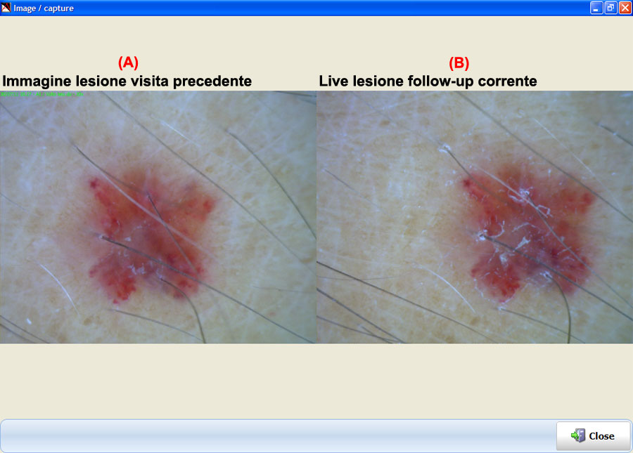 Acquisizione video di una lesione con la stessa immagine acquisita precedentemente. La dermoscopia economica anche portatile permette differenti tipi di esame, dal semplice screening delle lesioni melanocitiche pigmentate ai sospetti casi di neoplasia cutanea, fino alla diagnosi differenziale delle connettiviti a carattere autoimmune. Il suo ruolo è inoltre documentato nel follow-up post-intervento in chirurgia estetica e di asportazione di formazioni neoplastiche maligne e nel monitoraggio del trattamento con UVA della psoriasi.